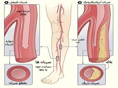 انسداد شریانی