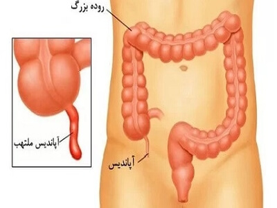 بیماری آپاندیس چیست