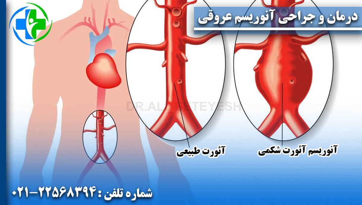 درمان و جراحی آنوریسم عروقی