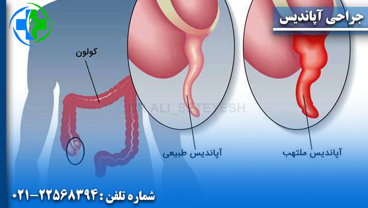 جراحی آپاندیس