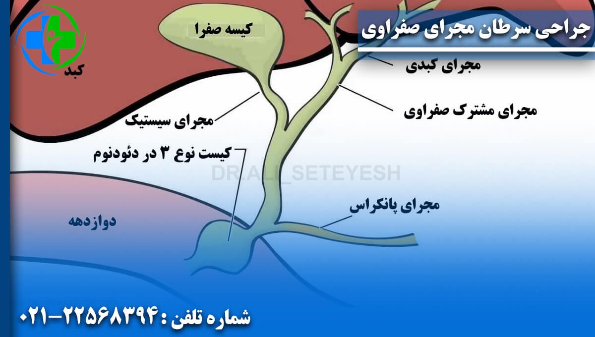 جراحی سرطان مجرای صفراوی