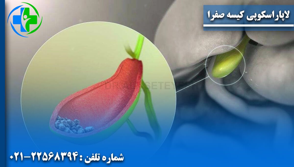 لاپاراسکوپی کیسه صفرا