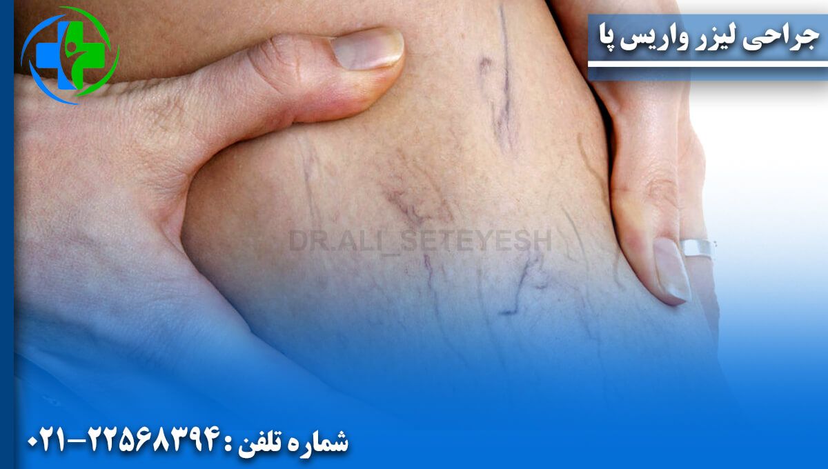 جراحی لیزر واریس پا
