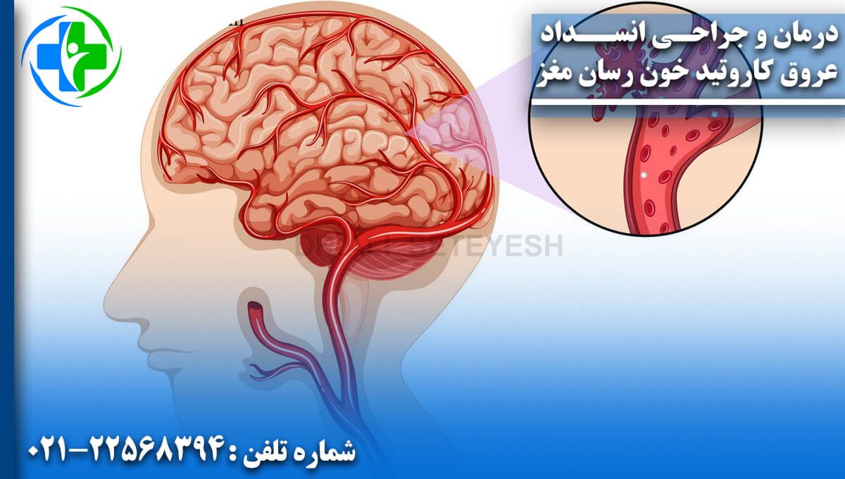 درمان و جراحی انسداد عروق كاروتيد خونرسان مغز