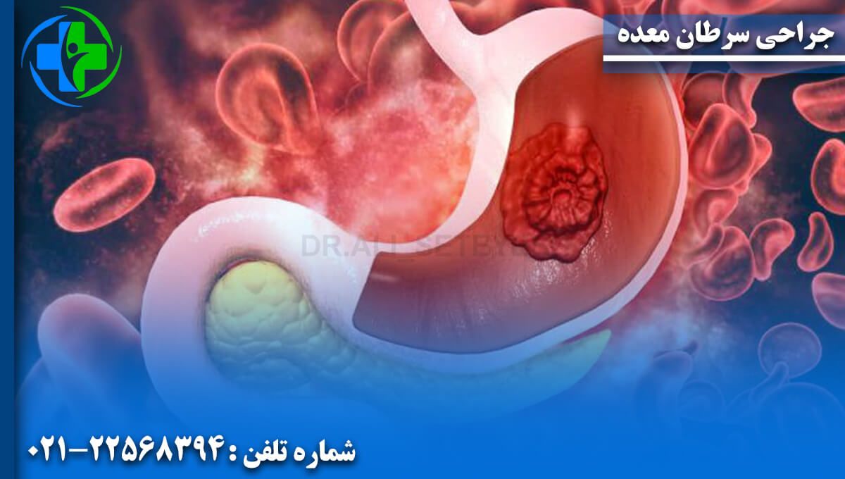 جراحى سرطان معده