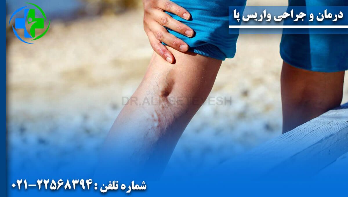 درمان و جراحی واریس پا